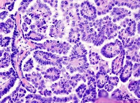 CancerRes：新研究发现帮助清除癌症干细胞的新靶标